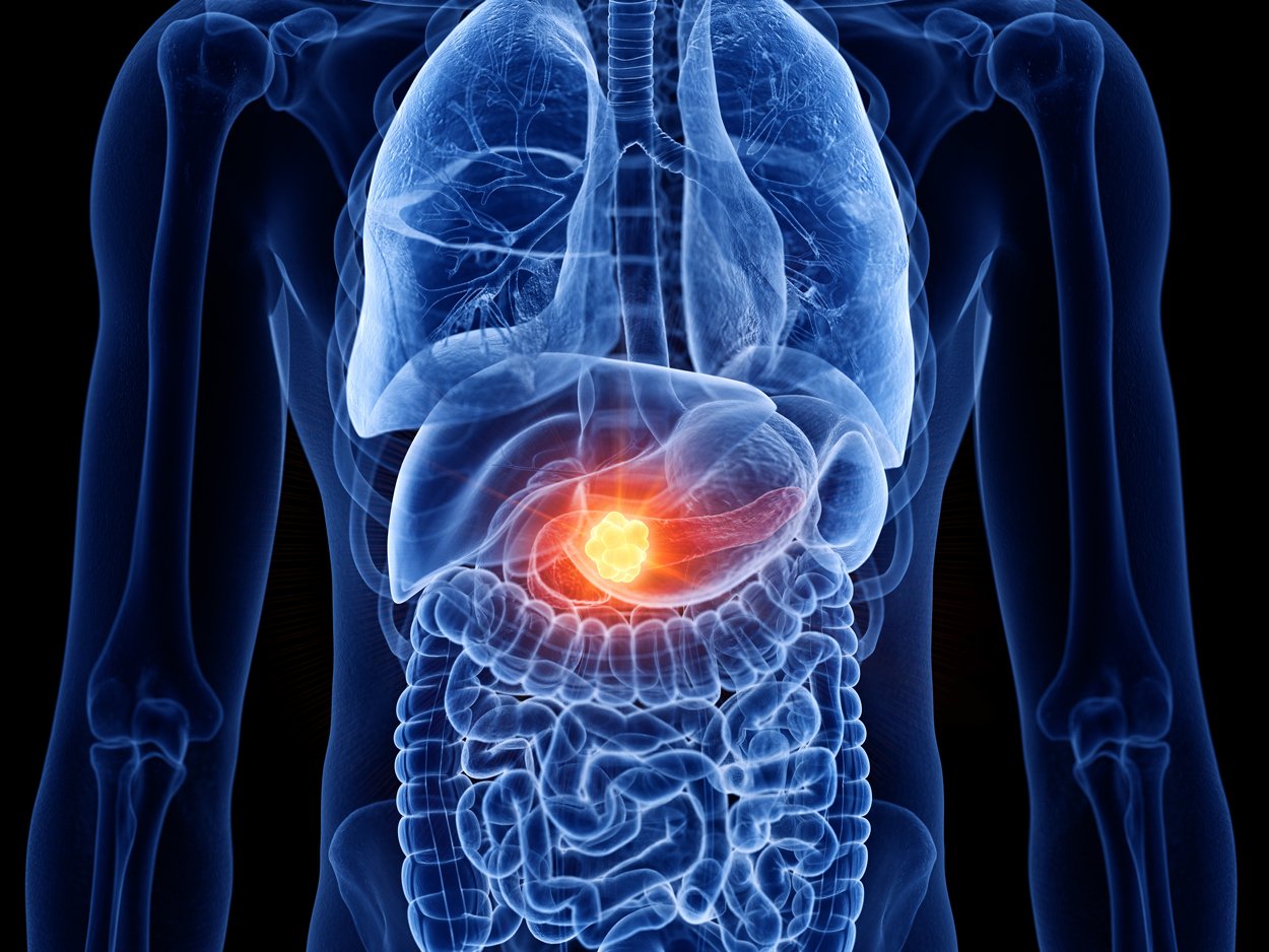 Targeted drug found effective in thwarting pancreatic tumors - Medical ...