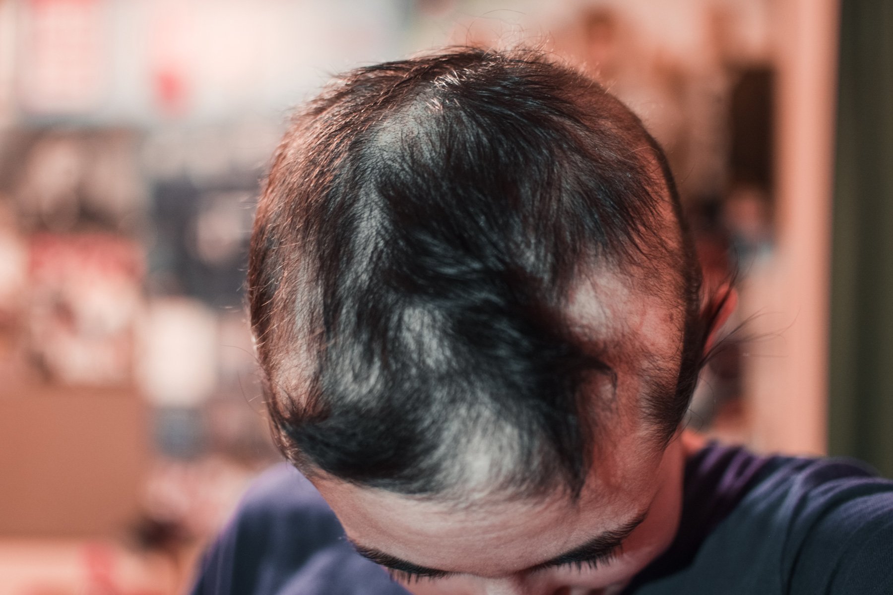 COVID vaccination linked to hair loss - Medical Update Online
