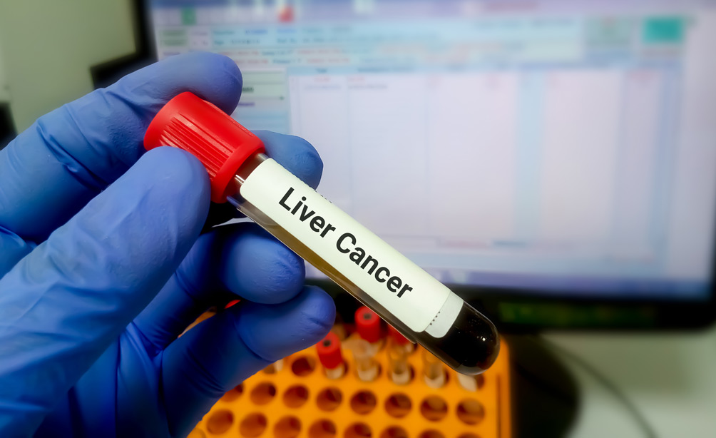 Genetic Testing For Liver Cancer Reference: Novel AI Blood Test Detects Liver Cancer