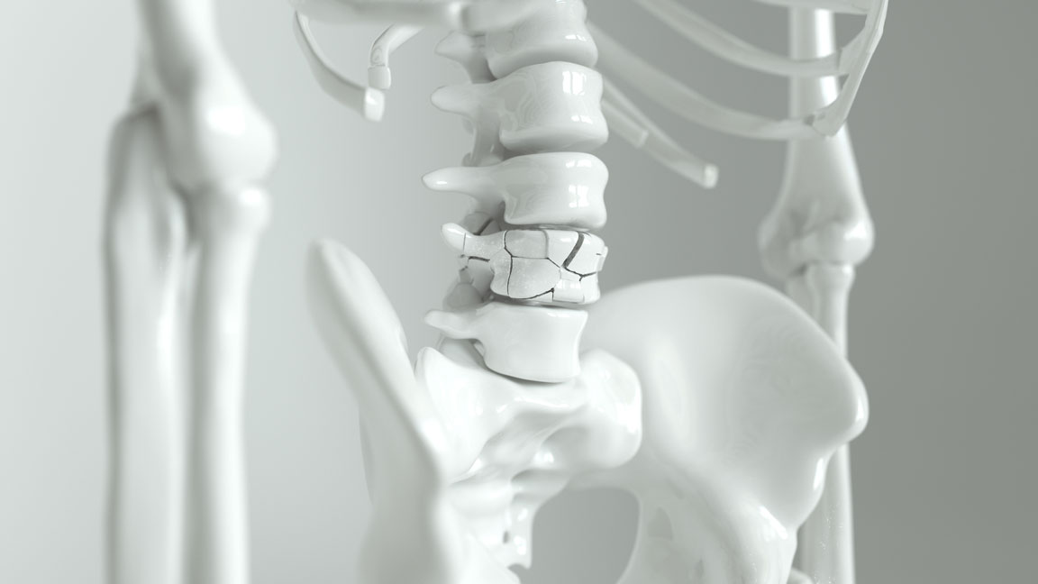 Comprehensive new Canadian guideline for skeletal health and fracture ...